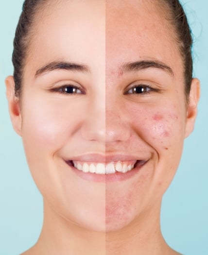 Acne treatments womens half face 1