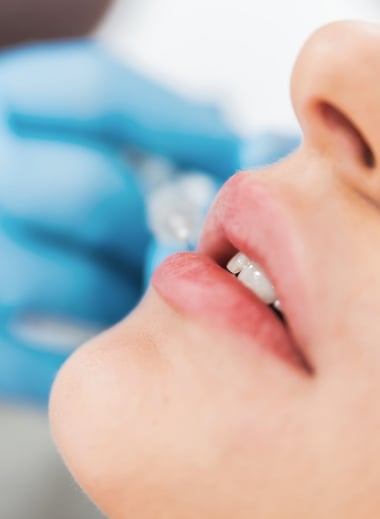 Dermal fillers Treatment face Dermal fillers Treatment face