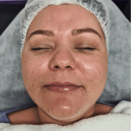 Post Dermaplaning woman face