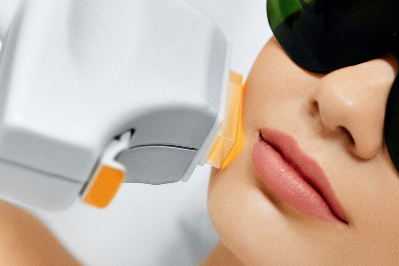 IPL for pigmentation and rejuv  3
