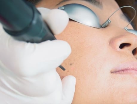 Laser skin resurfacing