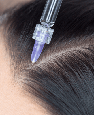 Mesotherapy for hair loss
