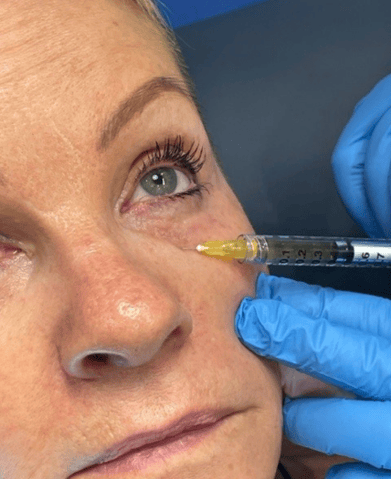 PRP therapy under-eyes