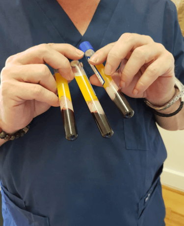 PRP therapy vials PRP therapy vials