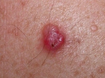 Nodular melanoma: What you need to know Nodular melanoma: What you need to know