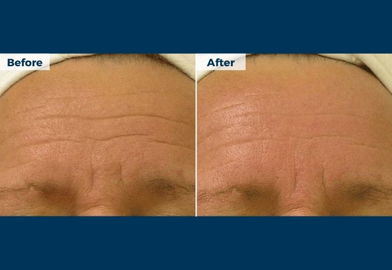 HydraFacial B&A (4)-1