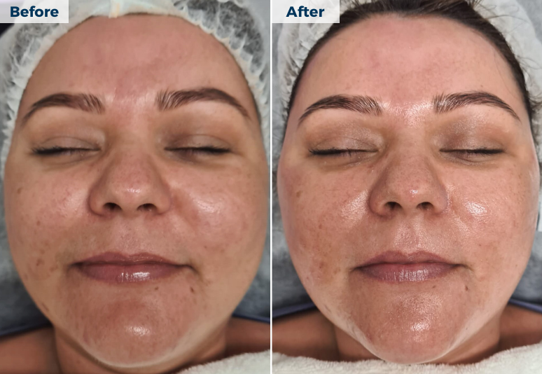 Hydrafacial112