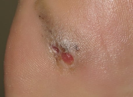 Can skin cancer look like a blood blister
