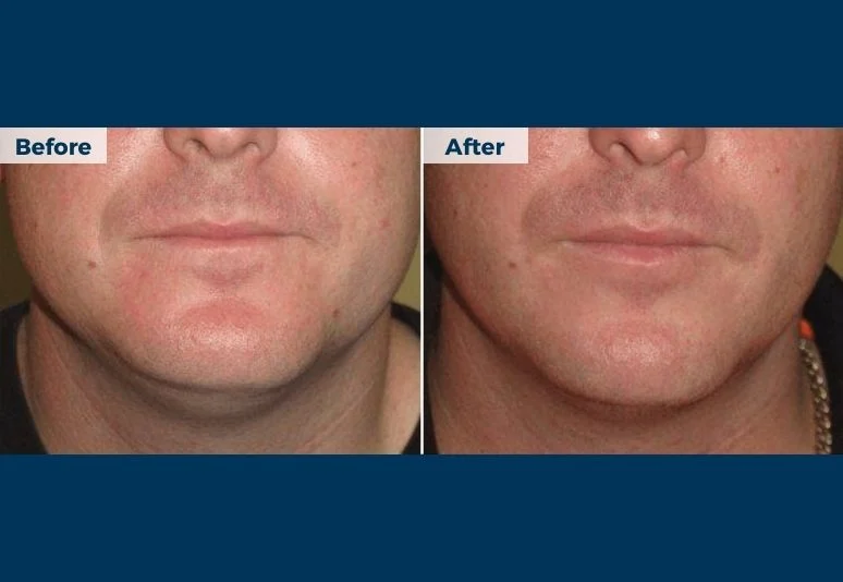 Lipodissolve B&A (5)