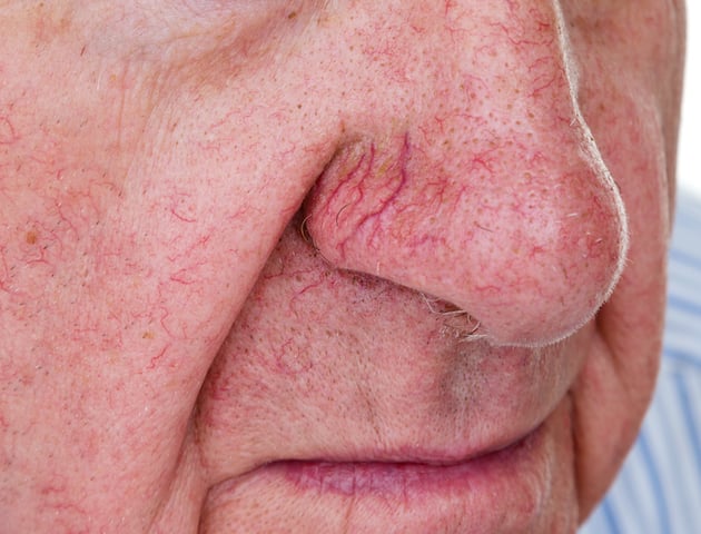 Facial vein removal image