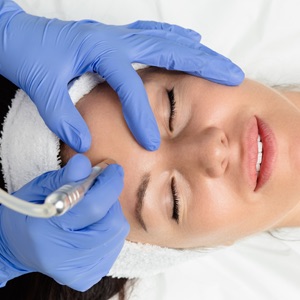 Microdermabrasion  image