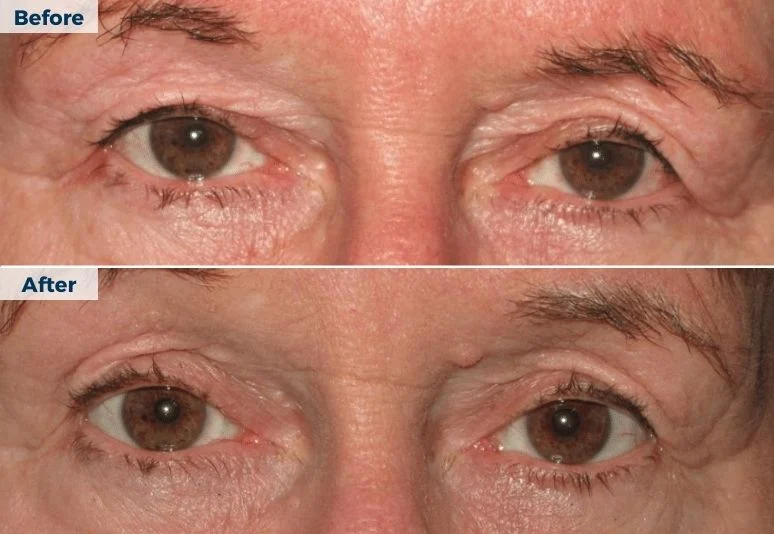 Plasma Pen Skin Tightening B&A (1)