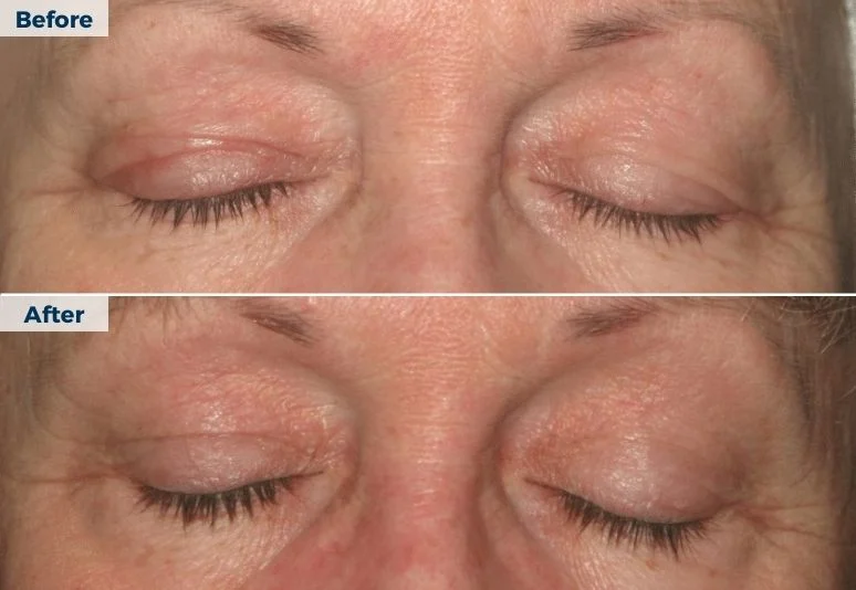 Plasma Pen Skin Tightening B&A (6)