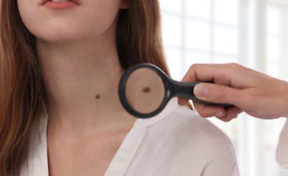 Everything you need to know about growing new moles after 30