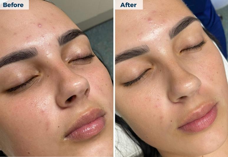 Bayside Hydrafacial 1 B&A