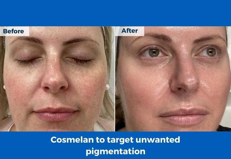 Birtinya Pigmentation Correction-1