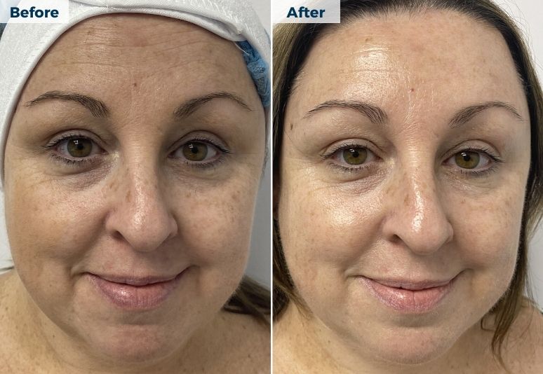 Chemical Peel B&A (1)