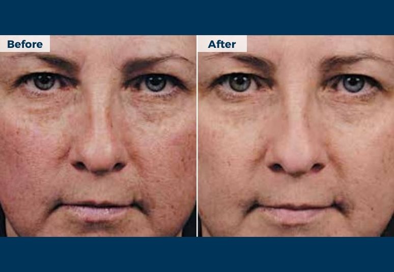 Chemical Peel B&A (2)-1