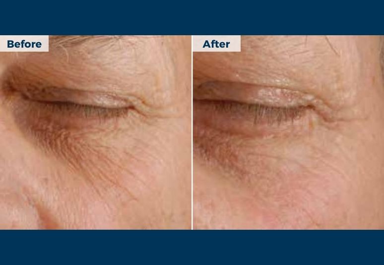 Chemical Peel B&A (3)-3