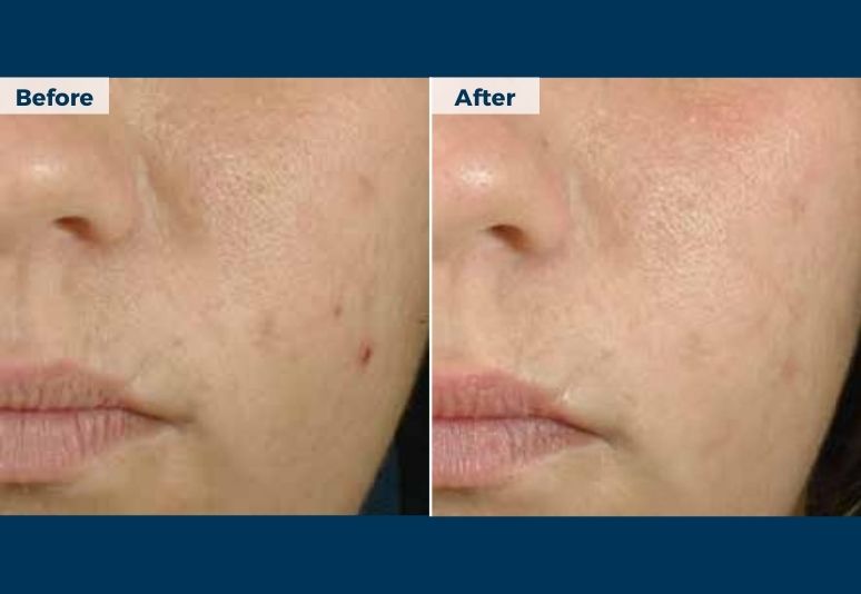 Chemical Peel B&A (4)-1