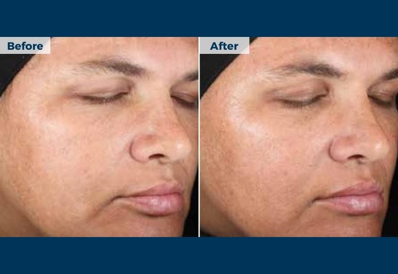 Chemical Peel B&A (5)-3