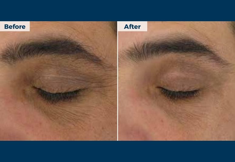 Chemical Peel B&A (6)-2