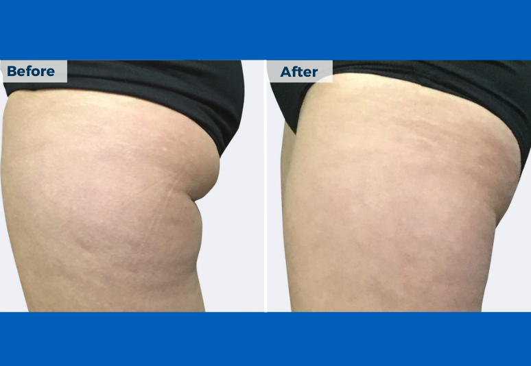 Coolsculpting B&A 1