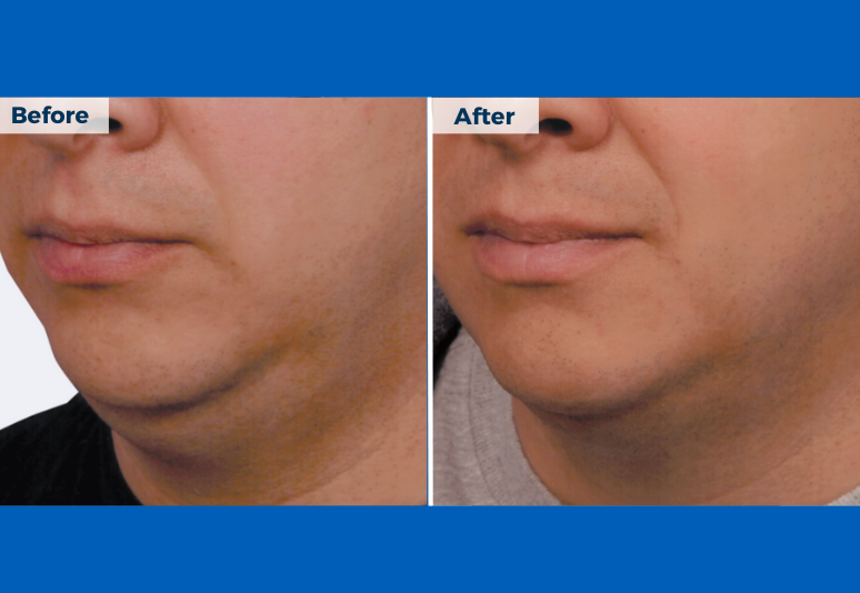 Coolsculpting B&A 2