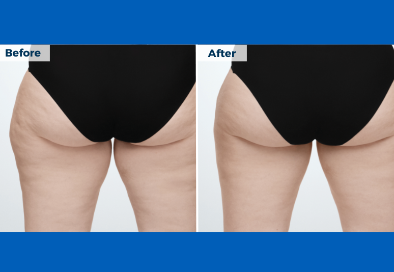 Coolsculpting B&A 3