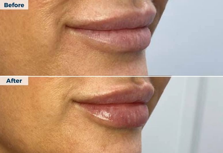 Dermal Fillers B&A  (1)