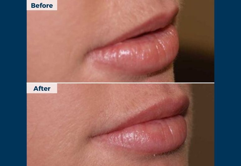 Dermal Fillers B&A  (3)-1