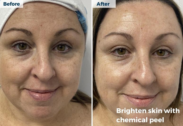 Devonport - Anti Ageing after peel-1