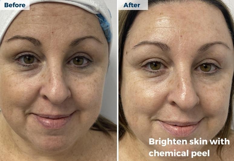 Devonport - Anti Ageing after peel