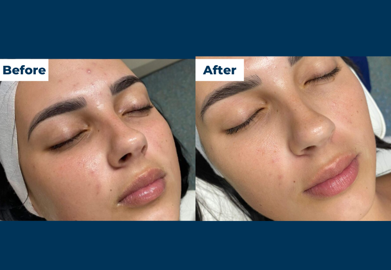 HydraFacial 8 B&A