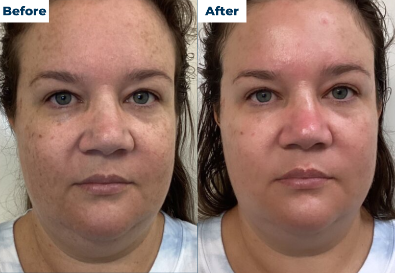 HydraFacial 9 B&A