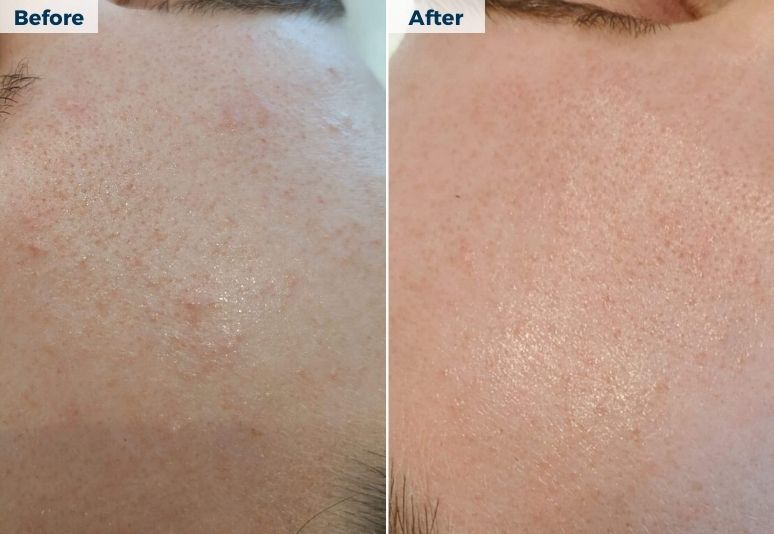 HydraFacial B&A (1)