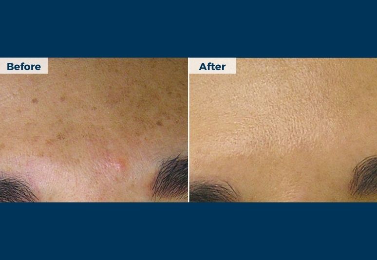 HydraFacial B&A (3)