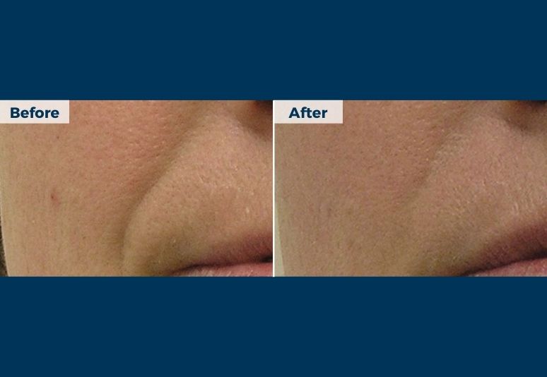 HydraFacial B&A (5)-1