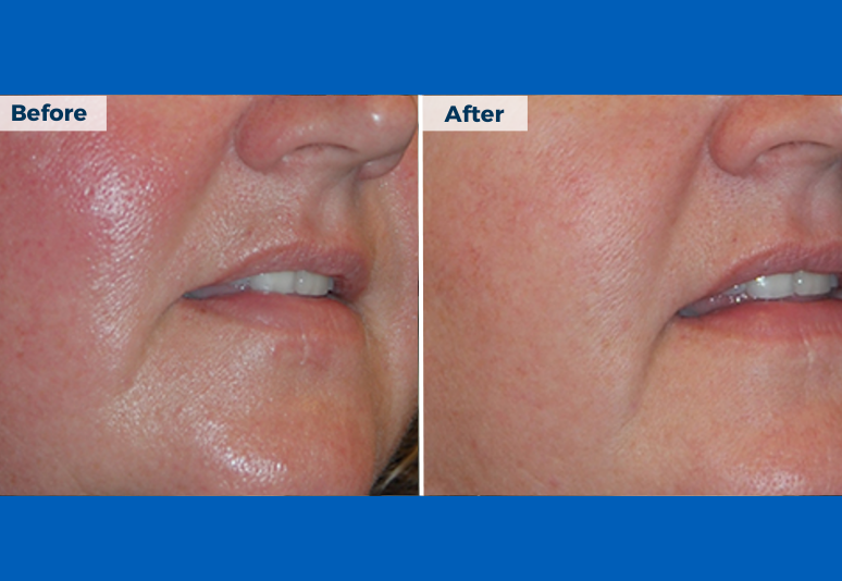 Laser for pigmentation2