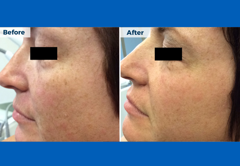 Laser for pigmentation5