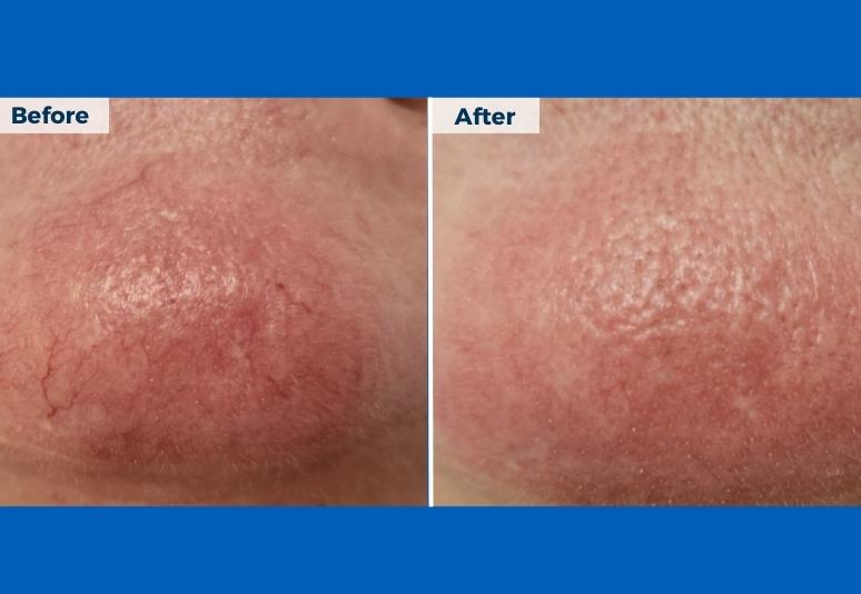 Laser for redness B&A 1