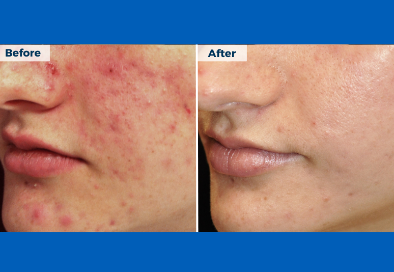 Laser for redness B&A 2