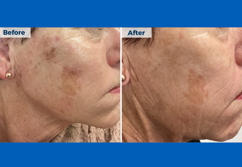 Laser for redness B&A 4