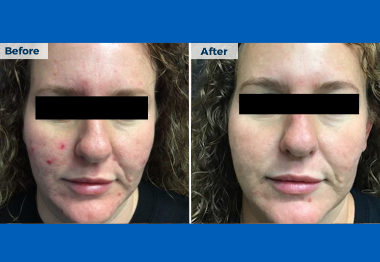 Laser for redness B&A 6