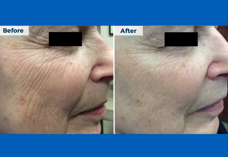 Laser for redness B&A 7