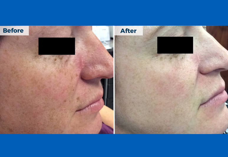 Laser for redness B&A 8