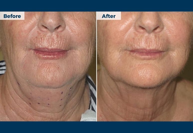 Lipodissolve B&A (1)