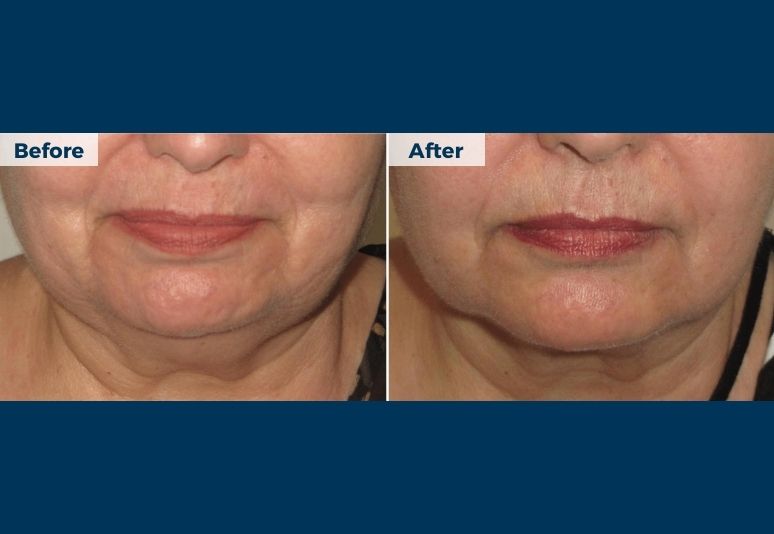Lipodissolve B&A (3)