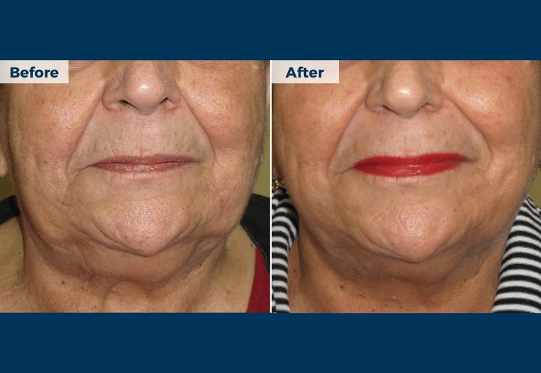 Lipodissolve B&A (6)