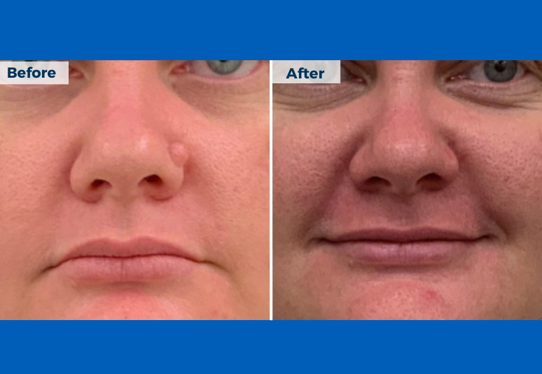 Mole removal 1 B&A1